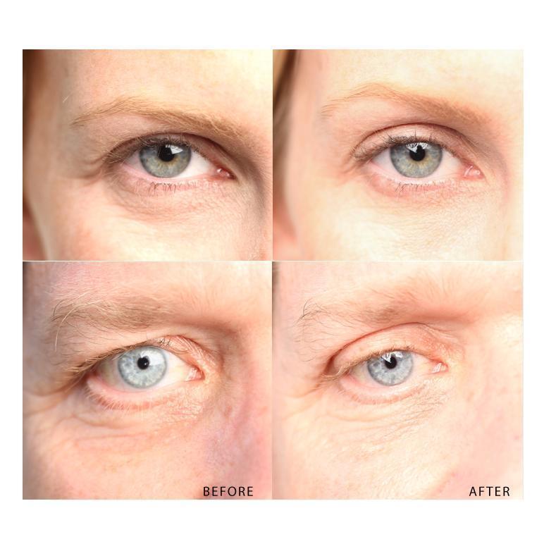 Say NO to Aging! Familiarize Yourself with this Anti Aging Eyelid Tape