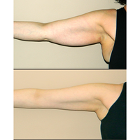 Lymphatic Drainage Ginger Oil: Reduce Pain Immediately