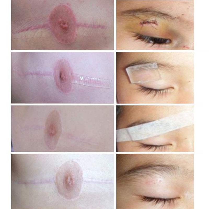 Silica Scar Therapy Patch