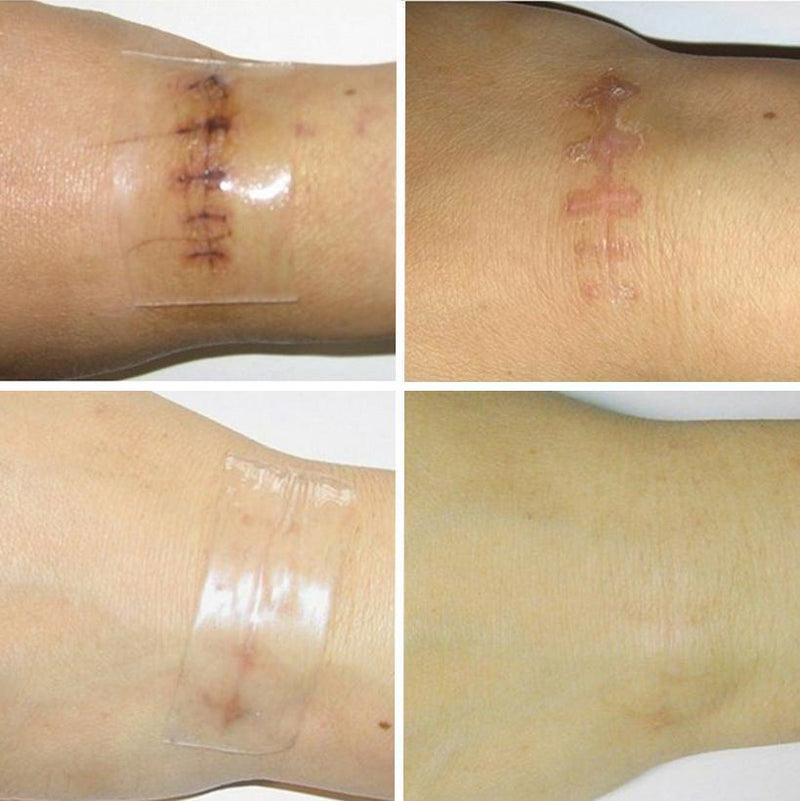Silica Scar Therapy Patch