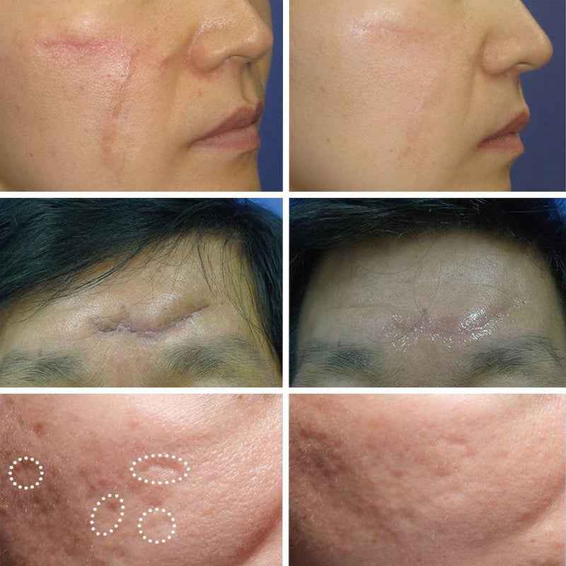 Silica Scar Therapy Patch